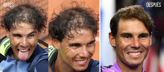 Antes y después Rafa Nadal