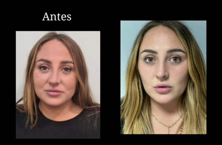 El antes y después de la bichectomía de Rocío Flores