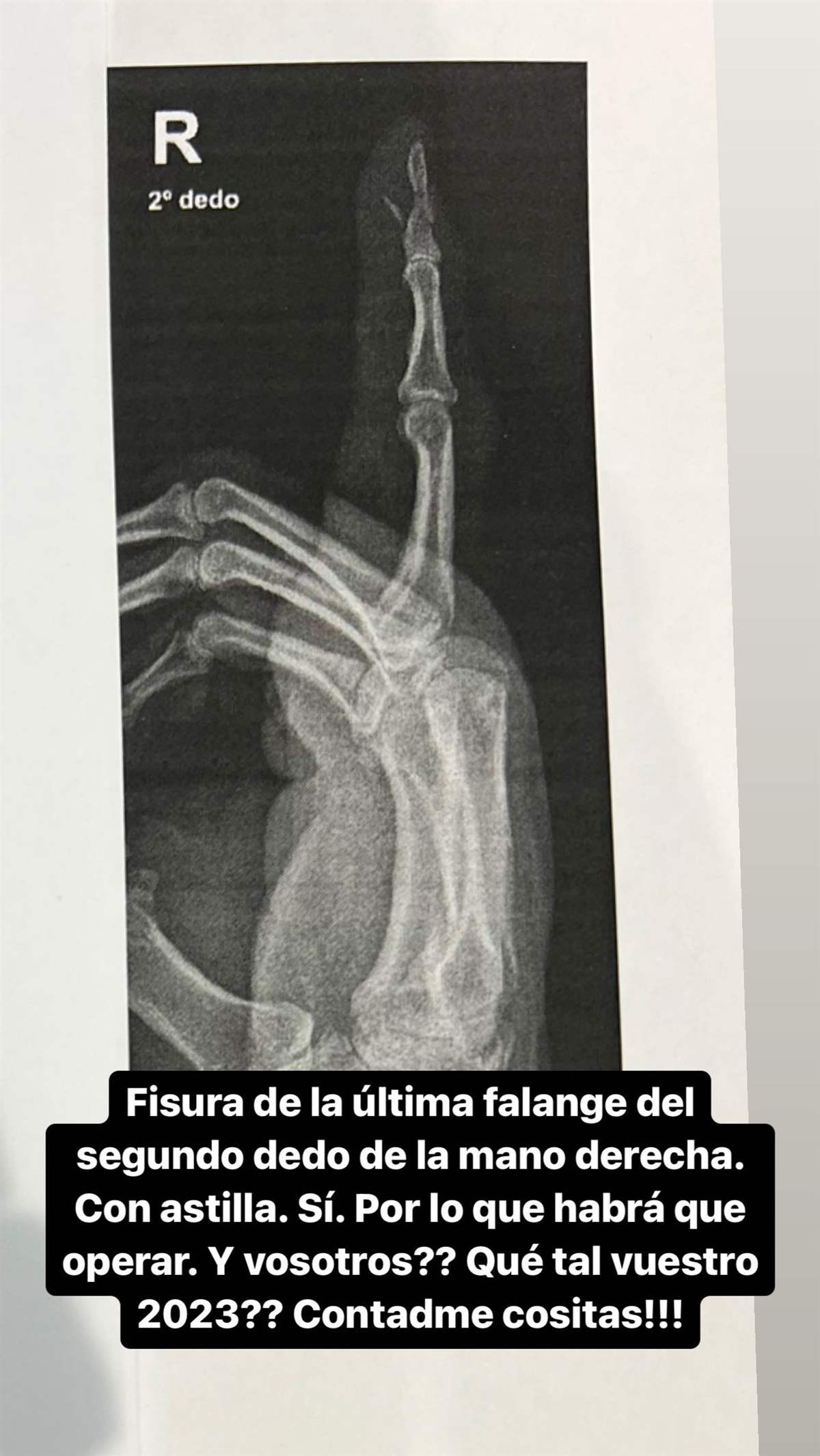 Radiografía del dedo roto de Risto Mejide.