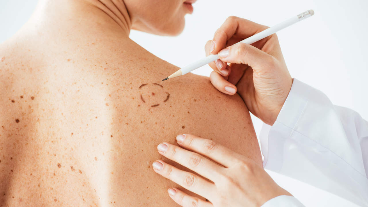 BC Melanoma