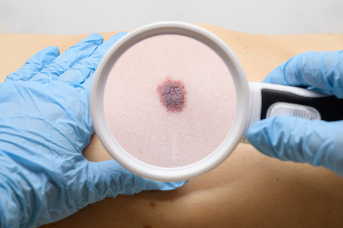BC Melanoma
