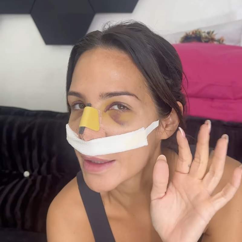 Tamara Gorro enseña su nuevo rostro solo 8 días después de operarse
